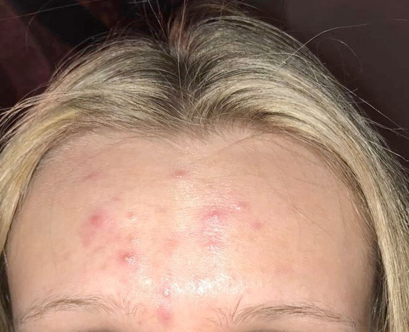 Westshore Skin & Health Center Before & After treatment photos