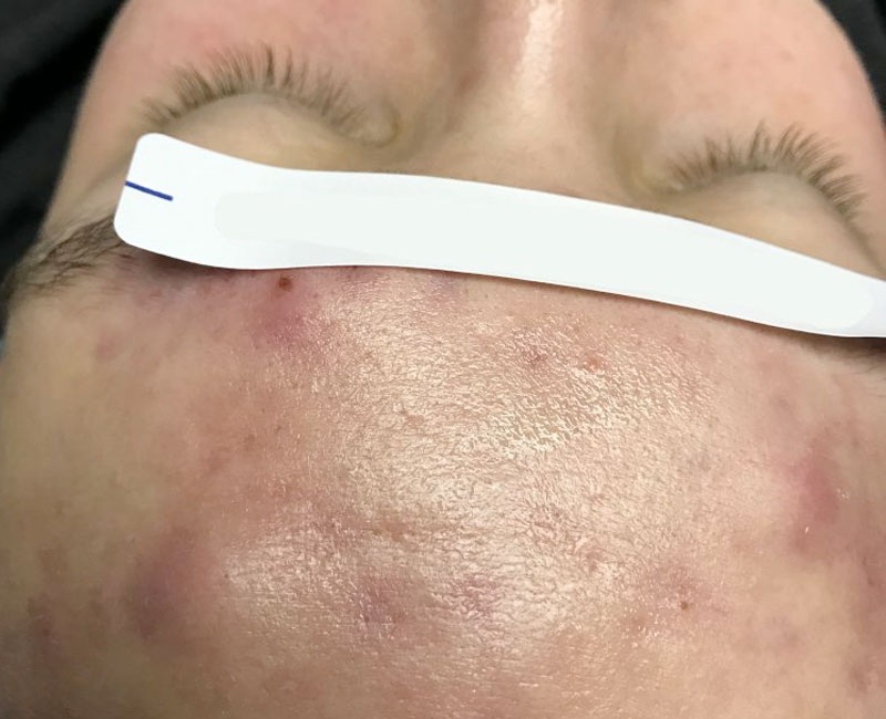 Westshore Skin & Health Center Before & After treatment photos